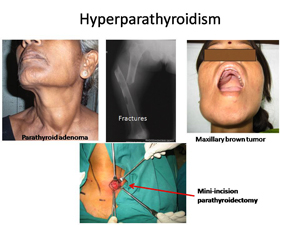 parathyroid adenoma